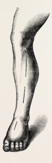 ligature, medical equipment, surgical instrument, history of medicine