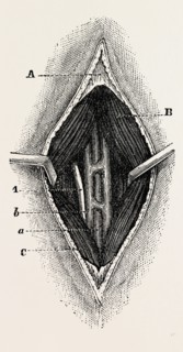 tractor, the outer border of the ligature, medical equipment, surgical instrument, history of