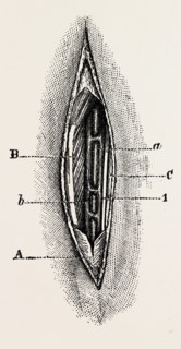 ligature, medical equipment, surgical instrument, history of medicine