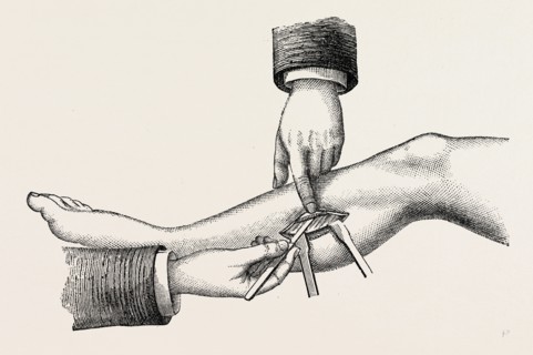 the mode of dividing the solidus muscle in ligature, medical equipment, surgical instrument,