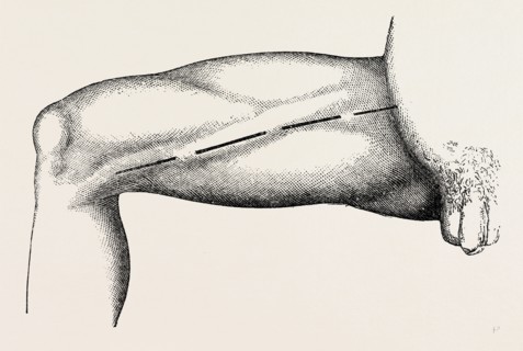 ligature of the right common femoral at the base of scarpa's, medical equipment, surgical
