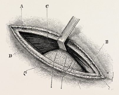 ligature of right external iliac artery, medical equipment, surgical instrument, history of