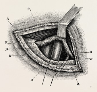 ligature of right external iliac artery, medical equipment, surgical instrument, history of