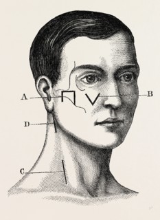 a neurotomy of third division, medical equipment, surgical instrument, history of medicine