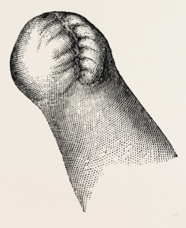 stump of right, medical equipment, surgical instrument, history of medicine