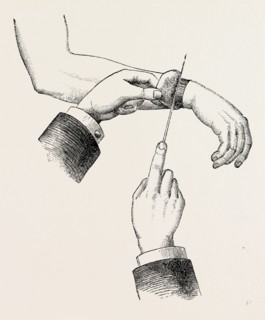 circular amputation de la manchette, medical equipment, surgical instrument, history of medicine