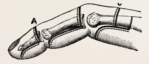 disarticulations, medical equipment, surgical instrument, history of medicine