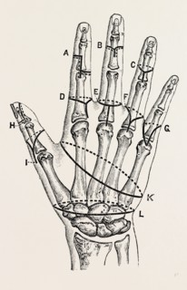 disarticulation by single external, medical equipment, surgical instrument, history of medicine