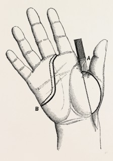 disartieulation of the thumb, medical equipment, surgical instrument, history of medicine