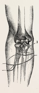 disarticulation, medical equipment, surgical instrument, history of medicine