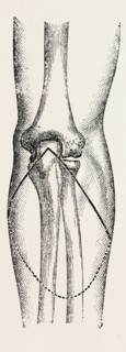 disarticu- ikemorritage.Ã¢â‚¬â€ùin addition to muscular, medical equipment, surgical instrument,