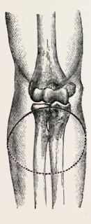 disarticulation, medical equipment, surgical instrument, history of medicine
