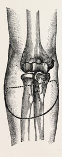 disarticulation, medical equipment, surgical instrument, history of medicine