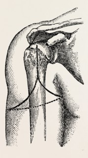 disarticulation, medical equipment, surgical instrument, history of medicine