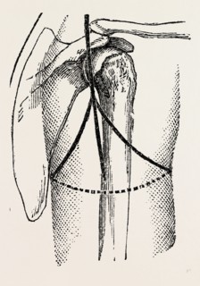 disaetictjlation at the posterior part of the oval, medical equipment, surgical instrument, history