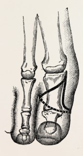 disarticulation, medical equipment, surgical instrument, history of medicine