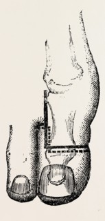 disarticulation, medical equipment, surgical instrument, history of medicine