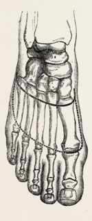 lisfranc's amputation, medical equipment, surgical instrument, history of medicine