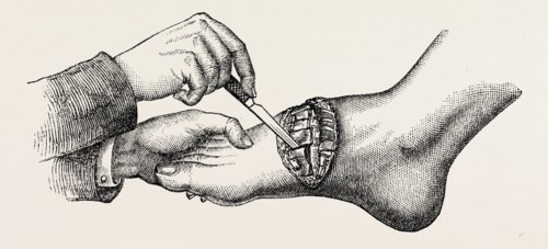 the coup de maitre in lisfrancis amputation, first step, medical equipment, surgical instrument,