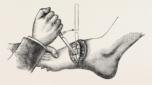 the coup de maitre in lisfrancis amputation, second step, medical equipment, surgical instrument,