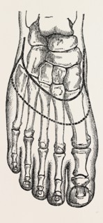 chopart's amputation, medical equipment, surgical instrument, history of medicine