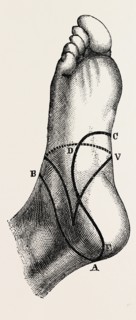 inner and outer sides of the right foot, to show the incisions, medical equipment, surgical