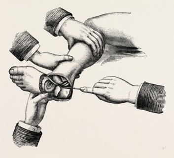 subastragaloid amputation of the left foot, after farabeuf, medical equipment, surgical instrument,