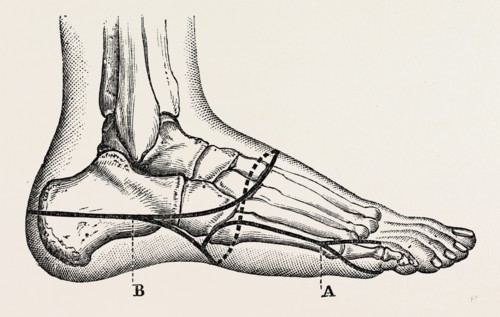 disarticulation of the little toe, medical equipment, surgical instrument, history of medicine