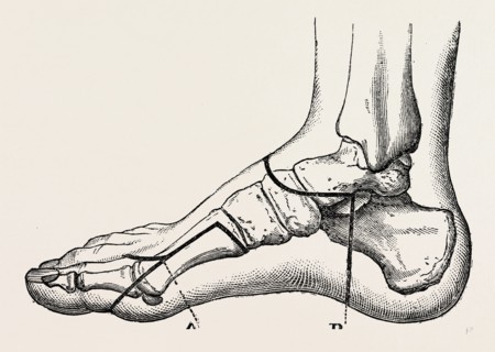 disarticulation of the great toe, medical equipment, surgical instrument, history of medicine