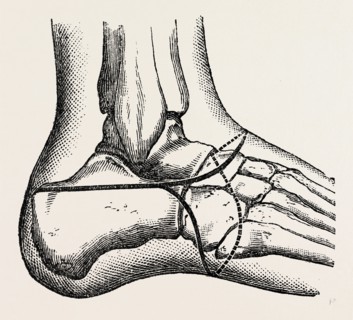 pasquier, medical equipment, surgical instrument, history of medicine