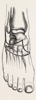tripier's, medical equipment, surgical instrument, history of medicine