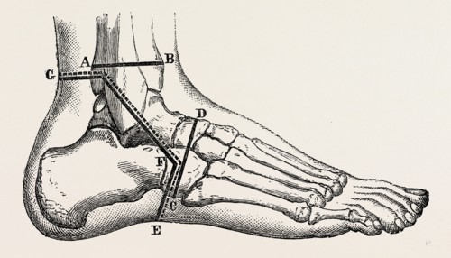 osteo-plastic resection of the foot, medical equipment, surgical instrument, history of medicine