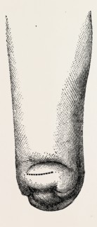 stump, medical equipment, surgical instrument, history of medicine
