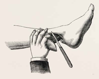mode of dividing the tissues in the amputation, medical equipment, surgical instrument, history of
