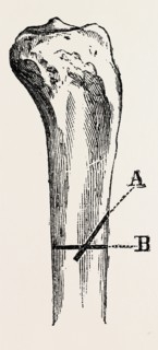 method of  method of sawing, medical equipment, surgical instrument, history of medicine