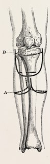 amputation, medical equipment, surgical instrument, history of medicine