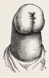 the stump, medical equipment, surgical instrument, history of medicine