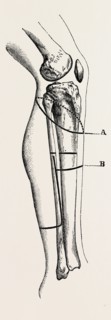 disarticulation isarticulation, medical equipment, surgical instrument, history of medicine