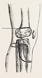 farabeuf's amputation, medical equipment, surgical instrument, history of medicine