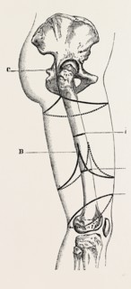 circular amputation of thigh, medical equipment, surgical instrument, history of medicine