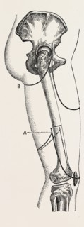 amputation, medical equipment, surgical instrument, history of medicine