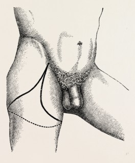 disarticulation, medical equipment, surgical instrument, history of medicine