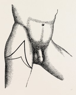 lisfrancs disarticulation, medical equipment, surgical instrument, history of medicine