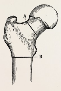 osteotomy, medical equipment, surgical instrument, history of medicine
