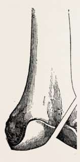 ogston's operation, medical equipment, surgical instrument, history of medicine