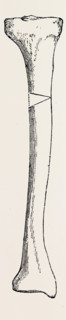 diagram representing a curved tibia, with a wedge removed, medical equipment, surgical instrument,
