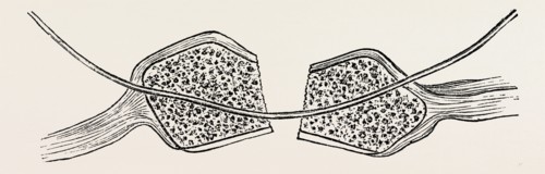 the fragments cut square and the wire in position, medical equipment, surgical instrument, history