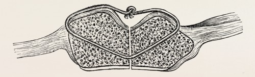 fragments in apposition, the wire knot hammered flat, medical equipment, surgical instrument,
