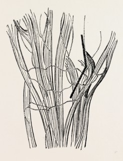 excision of the wrist, medical equipment, surgical instrument, history of medicine