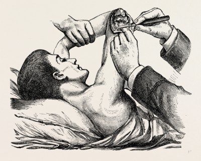 excision of the elbow, the clearing of the humerus, medical equipment, surgical instrument, history